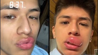 Wasp Sting On Poor Boy Lips Causes Massive Swelling  What Happens When A Wasp Stings You On Lips [upl. by Ahcmis883]