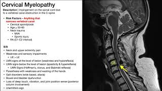 Cauda Equina Syndrome  Presentation Risk Factors amp SignsSymptoms [upl. by Elletnahs]