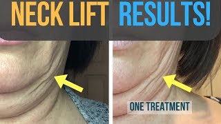 Results From My Fibroblast Plasma Neck Lift [upl. by Narag]