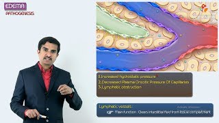 2Edema Pathogenesis  Hemodynamic pathology Fmge amp Neet PG [upl. by Tisha772]