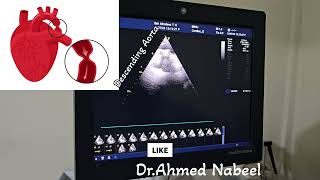 coarctation of Aorta 20 yrs old male missed and treated as a case of HTN 😱🙄 echocardiogram cardio [upl. by Aihseyn]