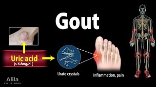 Gout Pathophysiology Causes Symptoms Risk Factors Diagnosis and Treatments Animation [upl. by Ttenaj]