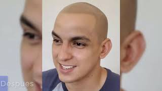 Remedio para la alopecia que realmente da resultados Antes y Despues Mty  MX [upl. by Elsilrac]