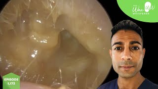 1173  Bursting Eardrum after Discharge amp Ear Wax Removal [upl. by French]