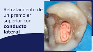 Retratamiento de un premolar superior con conducto lateral [upl. by Eloisa]