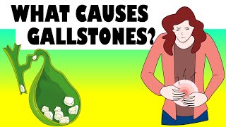 What Causes Gallstones Major Causes Of Gallstone Disease Gallstones Causes [upl. by Karolina533]