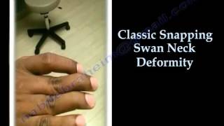 Swan Neck Deformity Classic Snapping [upl. by Yadroc593]