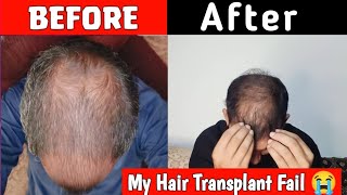 My hair transplant Fail 😭 11 Month Hair Transplant Transformation 😯 Hair Transplant 😮 Dr Habib [upl. by Adnalu]