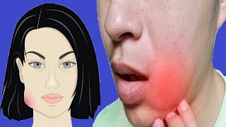 Swollen Cheek Causes And Prevention [upl. by Nordin297]