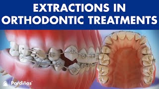 Extractions in Orthodontic Treatment  Is it necessary © [upl. by Dyane]