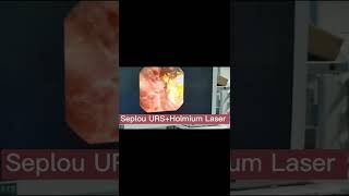 Holmium laser and Seplou URS in lithotripsy kidney stone [upl. by Ahseele]