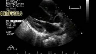 subaortic membrane and VSD 12 [upl. by Mikel]