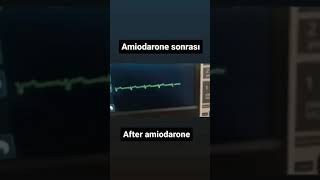 Amiodarone Magical Effect shorts emergency medical ryuseichannel [upl. by Aklam]