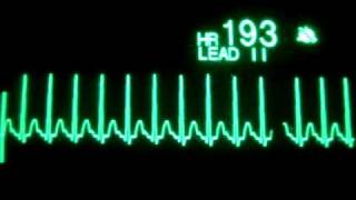 Supraventricular Tachycardia [upl. by Rowe]