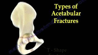 Acetabular Fractures  Everything You Need To Know  Dr Nabil Ebraheim [upl. by Cohl]