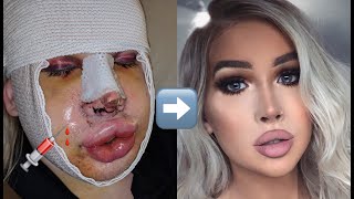 My Facial Feminization Surgery Story  Transgender FFS MTF [upl. by Gosney]