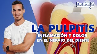 ¿Dolor intenso de muela Podría ser PULPITIS  Tratamiento INFLAMACIÓN NERVIO dental  Dentalk © [upl. by Lee]