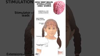 How Deep Brain Stimulation DBS Works medical animation 3d short [upl. by Bamby566]