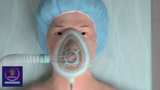 Inguinal Hernia Repair  Medical Animation Surgery [upl. by Brigg419]