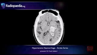 Stroke Hypertensive haemorrhage  radiology video tutorial MRI CT [upl. by Joceline]