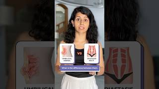 Difference between Umbilical Hernia and Diastasis Recti Postpartum Guide [upl. by Notneb]