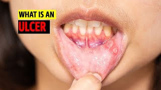 What is an Ulcer [upl. by Ofella]