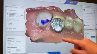 Cerec Tessera Workflow [upl. by Marlon]