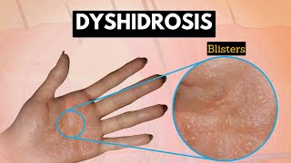 Dyshidrosis Causes Signs and Symptoms Diagnosis and Treatment [upl. by Arded]