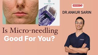 Facts about micro needling  Acne Scar Treatment  Dermapen 4  Morpheus 8 Dermaroller Dr Ankur [upl. by Aihcropal578]