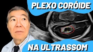 AO VIVO CISTO DE PLEXO CORÓIDE [upl. by Atinyl]