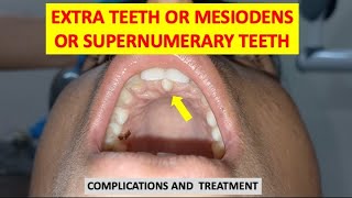 SUPERNUMERARY TEETH MESIODENS EXTRA TEETH COMPLICATIONS AND TREATMENT dentalcafe4331 [upl. by Gisella23]