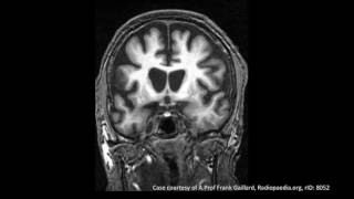 Huntingtons Disease [upl. by Zenger]