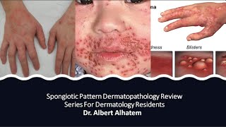 Dermatopathology Lesson 1 Spongiotic Dermatitis Tissue Reaction Patterns [upl. by Sesiom]