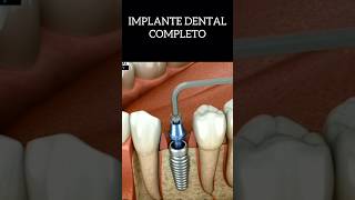 IMPLANTE COMPLETO shortsfeed dentista dentist dentistica dentistry resumosdeodonto implante [upl. by Casi]