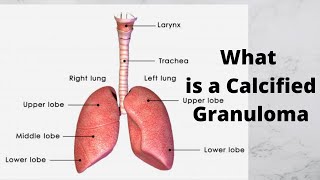 What is a Calcified Granuloma [upl. by Norrat808]