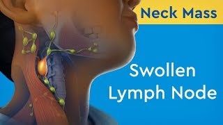 Neck Mass Swollen Lymph Node [upl. by Haelak148]