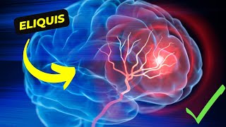 Eliquis The Revolutionary Anticoagulant for Stroke and Blood Clot Prevention [upl. by Charline]