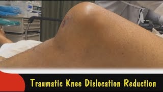 Traumatic Knee Dislocation Reduction [upl. by Delaryd585]