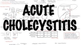 Acute Cholecystitis  Overview signs and symptoms pathophysiology treatment [upl. by Toffic]