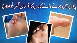 Corn  Callus  Wart l Corn Kyu Hota Hai Foot Corn Ke Ilaj In Urdu Hindi  Simple Home Remedies [upl. by Brine]