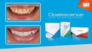 Professional Results with Opalescence™ teeth whitening [upl. by Carn340]