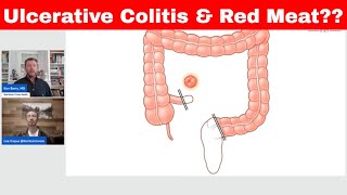 Ulcerative Colitis amp Red Meat Warning KENTCARNIVORE [upl. by Llertniuq]