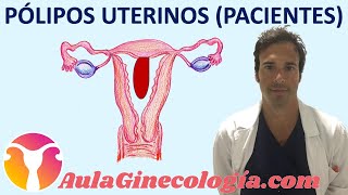 PÓLIPOS UTERINOS PACIENTES Síntomas diagnóstico y tratamiento  Ginecología y Obstetricia [upl. by Nibla]