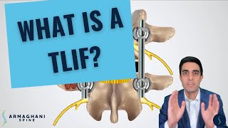 How I perform a TLIF and what to expect after [upl. by Bina98]