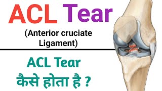 ACL TEAR  Anterior cruciate ligament tear shorts acltear acl [upl. by Townsend298]