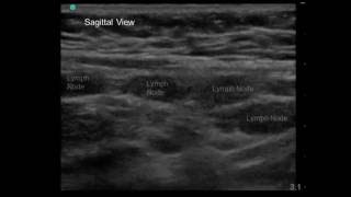 Mesenteric Adenitis in 7 yo Boy with Periumbilical Abdominal Pain and Vomiting [upl. by Carli]