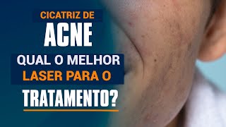 Cicatrizes de Acne  Qual o melhor laser para o tratamento [upl. by Derril958]