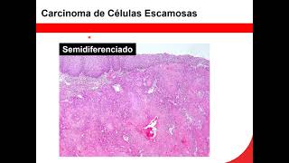 12 Neoplasias 3 pato anato Neoplasias malignas [upl. by Paulie]