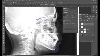 Cephalometrics Part 2 المرحلة الخامسة [upl. by Anaiad]