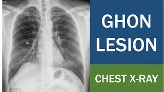 Ghon Lesion  Ghon Focus  Ghon complex  Tuberculoma  Tuberculous Caseating Granuloma  Chest Xray [upl. by Alauqahs424]